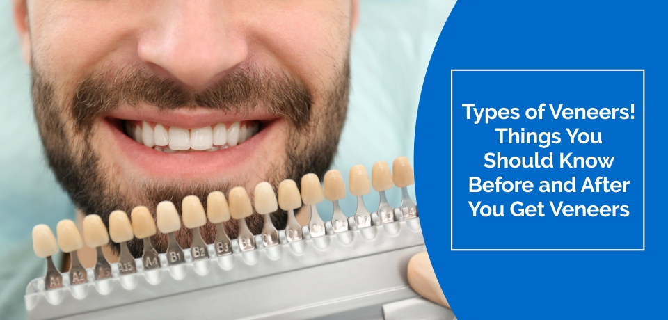 Types of Veneers | Things You Should Know Before and After You Get Veneers