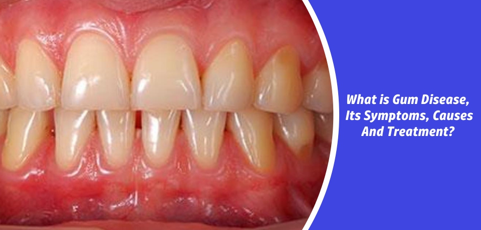 What Are Gum Disease?